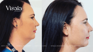 Nâng Chỉ Sinh Học Có Đau Không? Tìm Hiểu Thực TNâng Chỉ Sinh Học Có Đau Không? Tìm Hiểu Thực Tếế